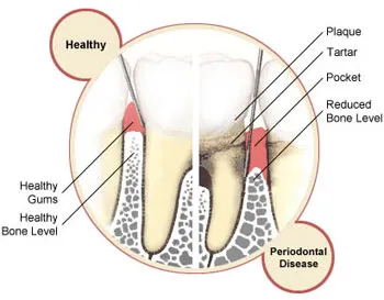perio disease