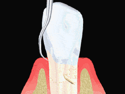 Tooth Scaling by Periodontist in Beverly Hills CA