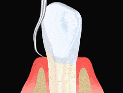 Tooth Scaling by Periodontist in Beverly Hills CA
