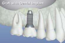 sinus lift illustration