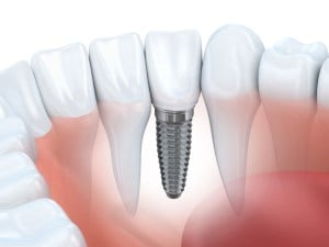 Dental Implants Beverly Hills CA