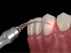 Laser Gum Surgery Beverly Hills CA