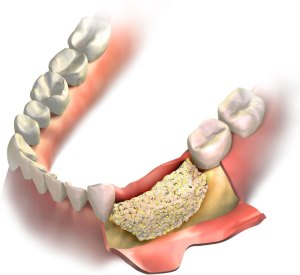 Bone Grafting