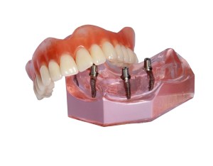 Tooth Replacement Beverly Hills, CA